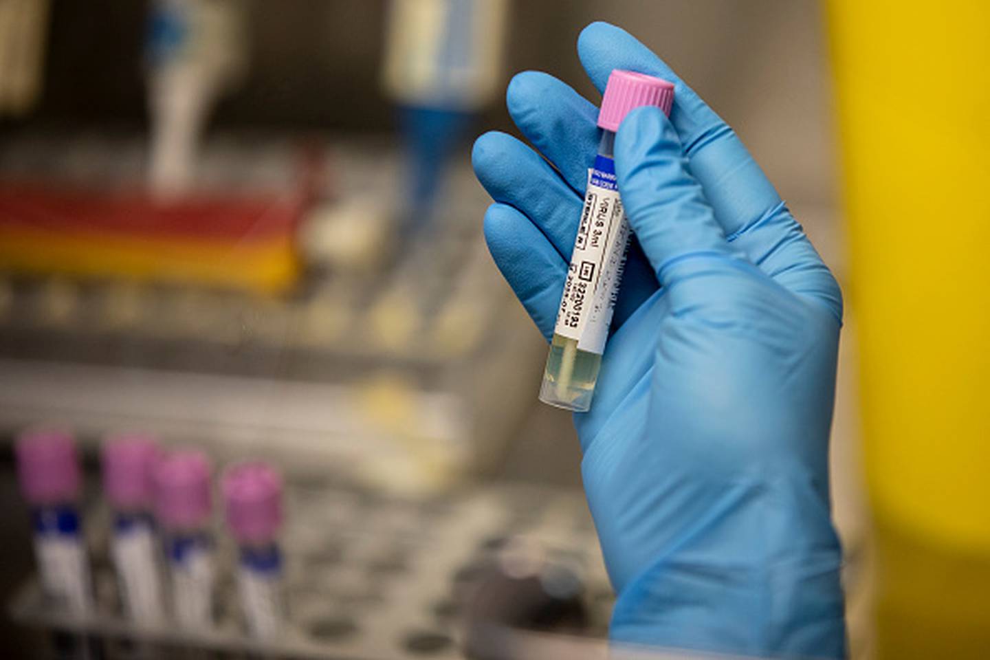 Un técnico de laboratorio médico muestra una muestra sospechosa de viruela del simio en el laboratorio de microbiología del Hospital La Paz el 6 de junio de 2022 en Madrid