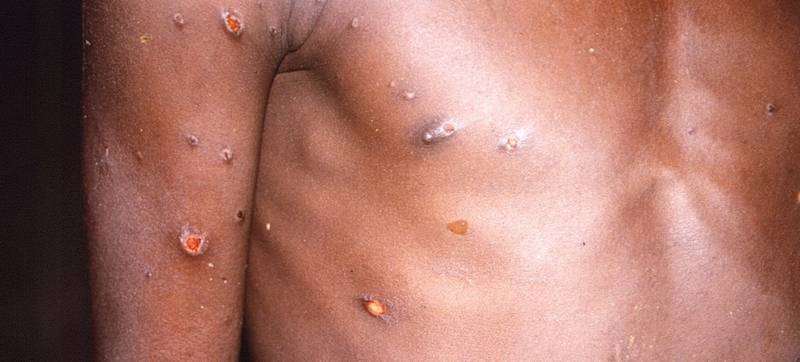La presencia de lesiones en la piel es el primer indicativo de la enfermedad.