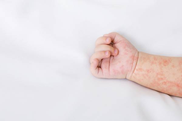 ¿Cuáles son los síntomas del sarampión y cómo identificarlos?