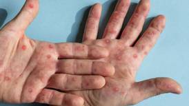 Alerta por sarampión: Secretaría de Salud pide completar esquemas de vacunación de los niños