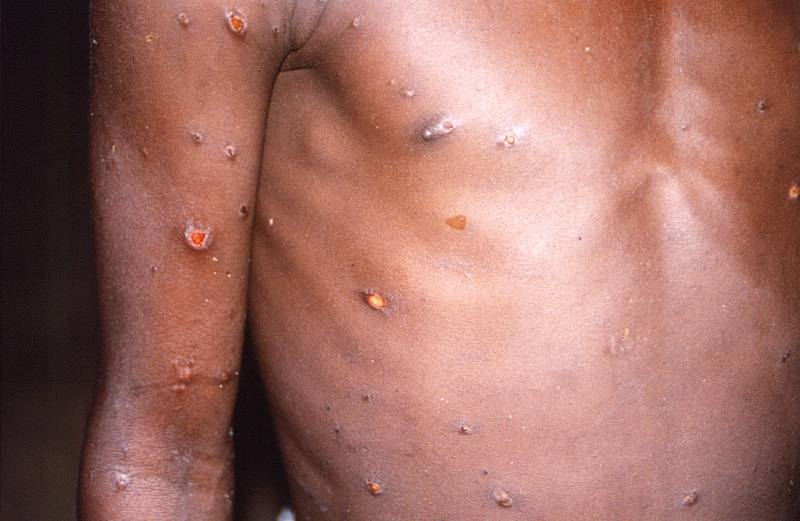 Según reportes de la OMS, hasta inicios de junio sumaban ya 780 casos de viruela símica en el mundo. Foto: AP