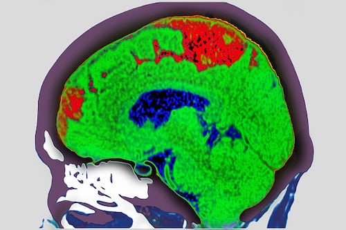 Aprueban en México nueva terapia para infarto cerebral que permite atención más rápida