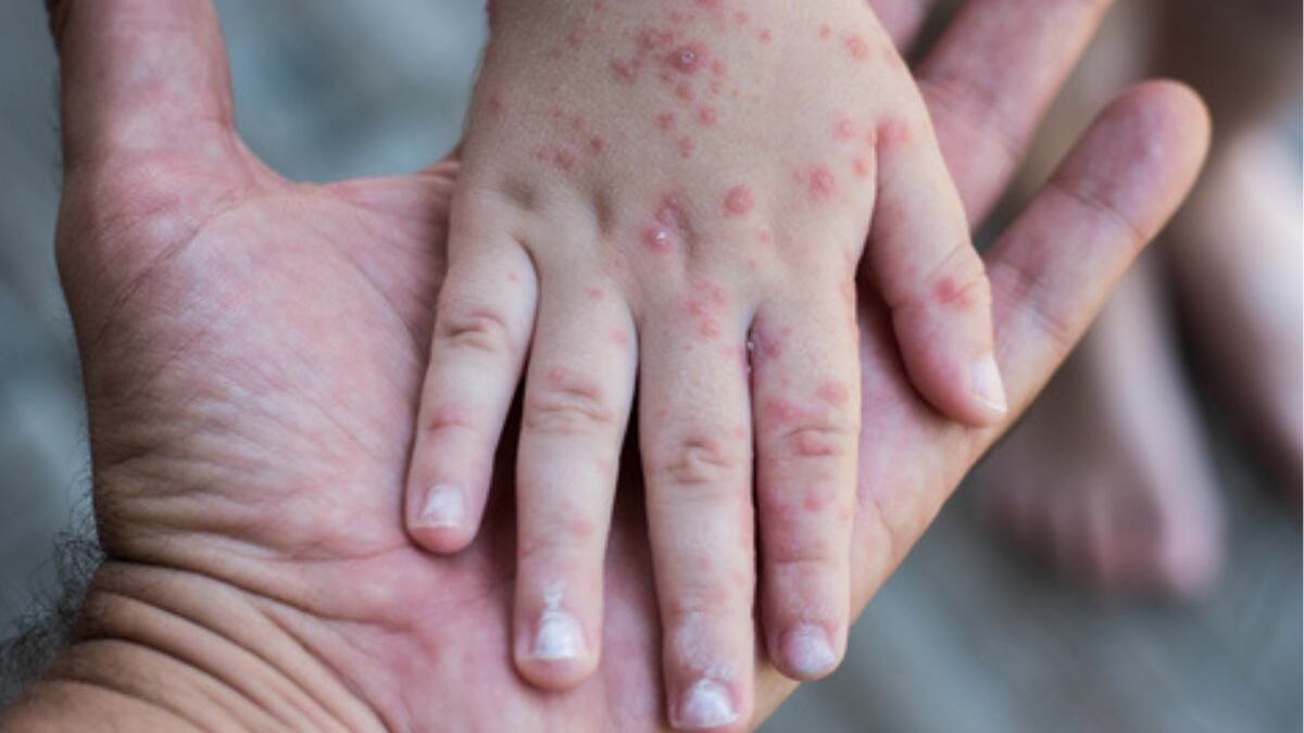 Brote de coxsackie en primaria de Oaxaca.