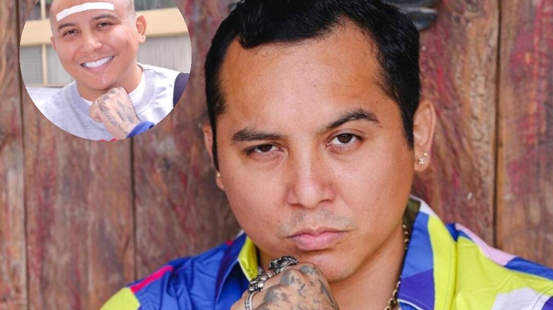 El líder de La Trakalosa se injertó cabello, lo que le valió críticas en las redes sociales.