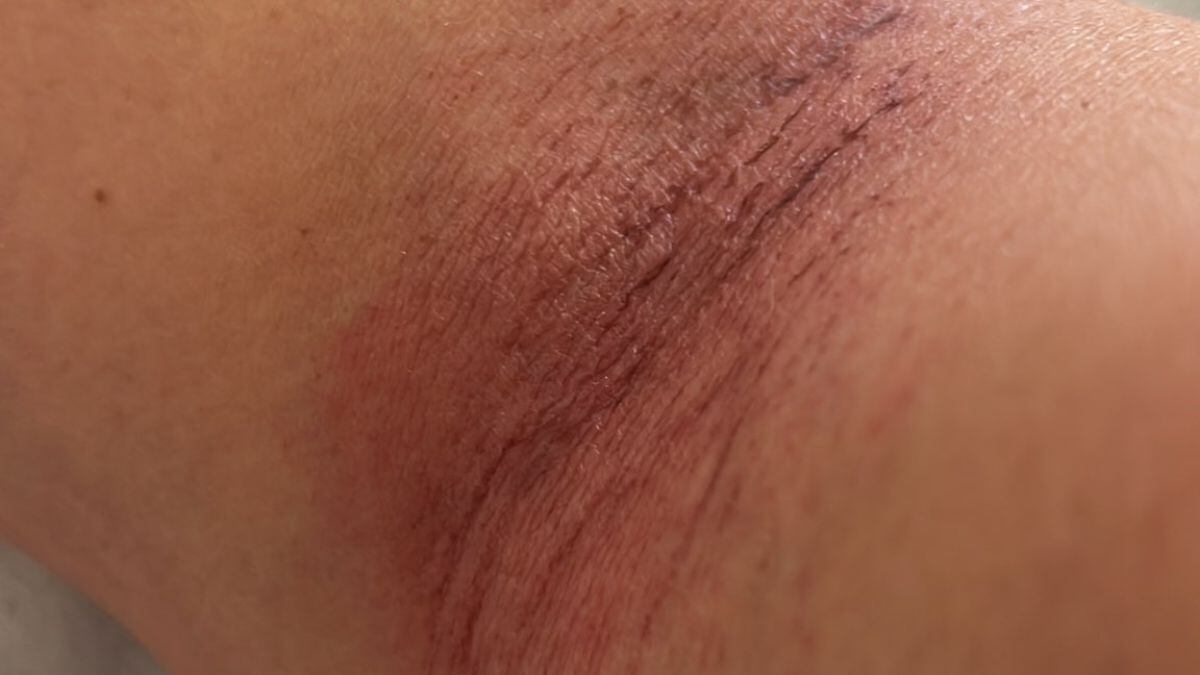 ¿Qué problemas de salud presentaron más de 800 personas por agua contaminada en Benito Juárez?