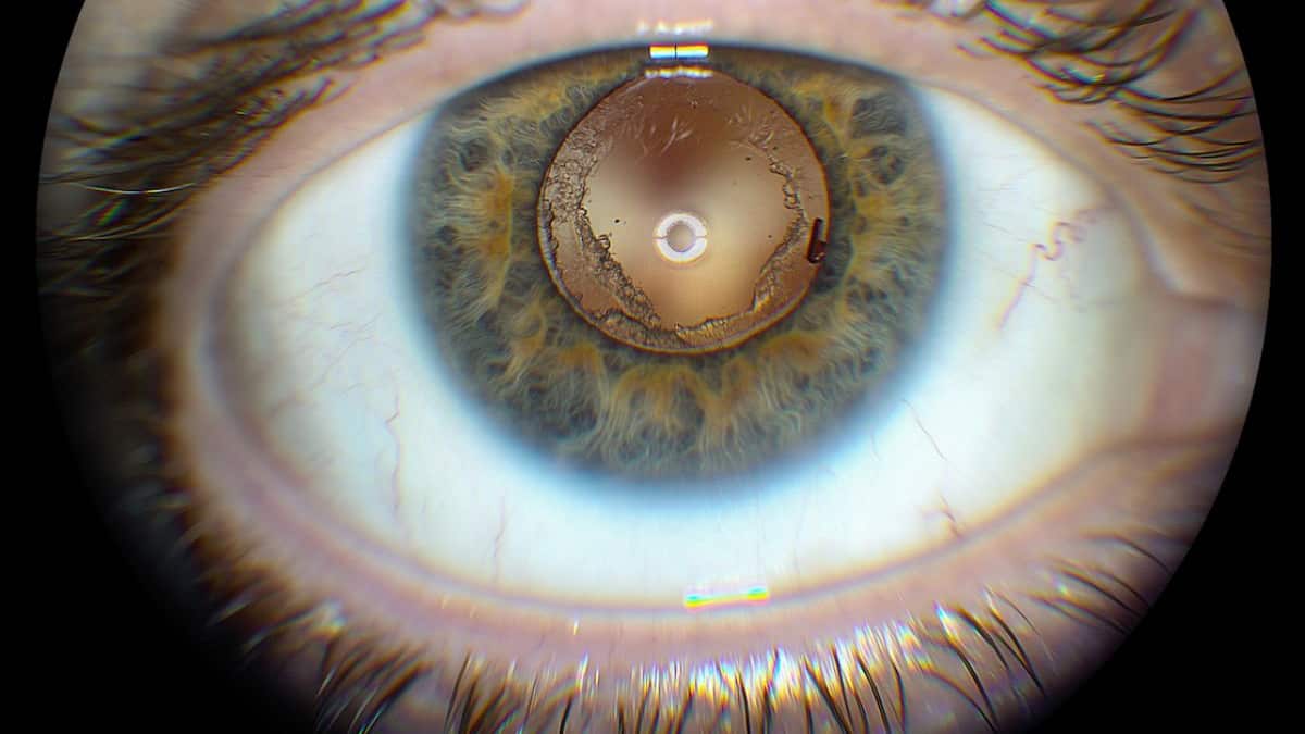 Eclipse: Mujer se daña la vista por no usar lentes de protección ocular