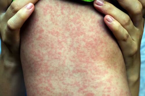 Aumentan casos de sarampión en EE.UU y Canadá: OPS; México emite alerta