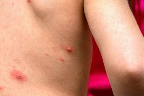 Chihuahua concentra 95% de contagios de sarampión; instalan cercos epidemiológicos