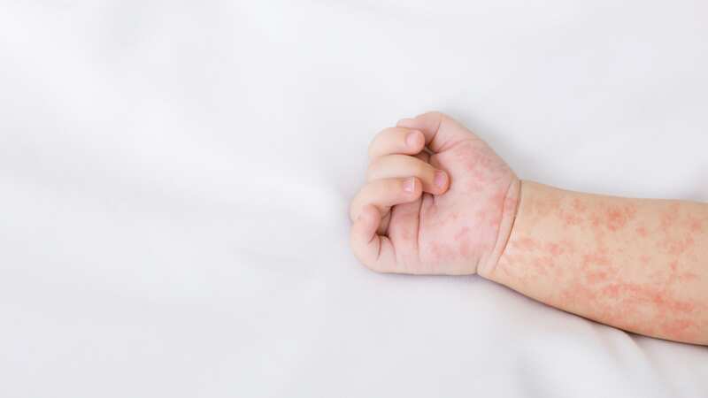 La enfermedad ha puesto en alerta al país. (Dreamstime)