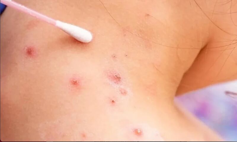 virus Coxsackie