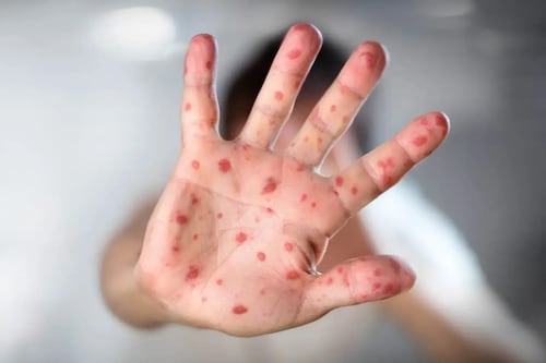 Se triplicaron casos de sarampión en un mes