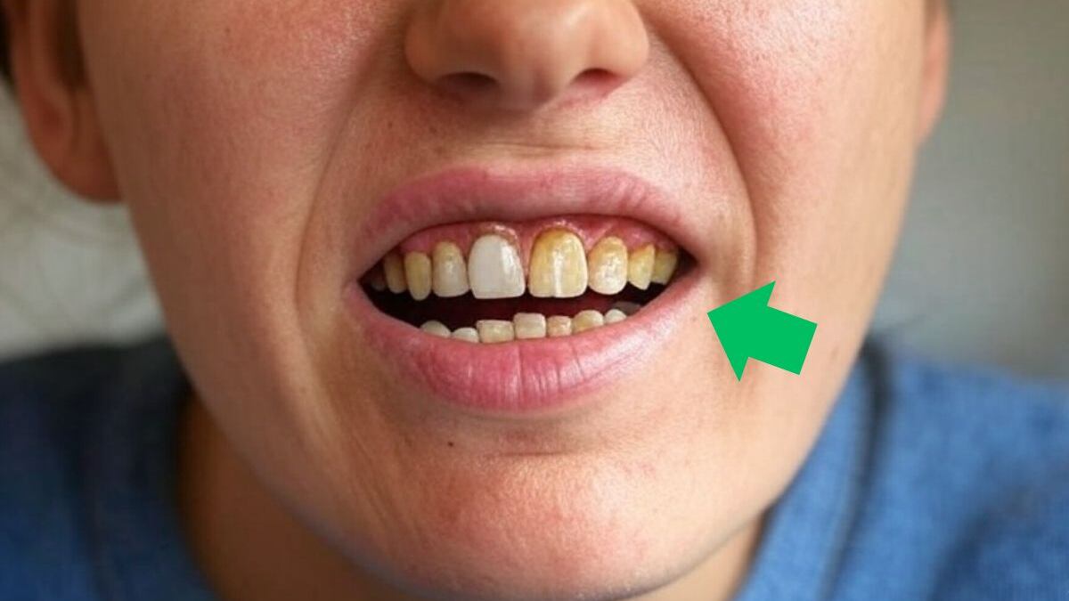 Carillas dentales: Gingivitis, fracturas y más, riesgos por mala colocación y falta de cuidado