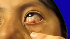 oncocersosis