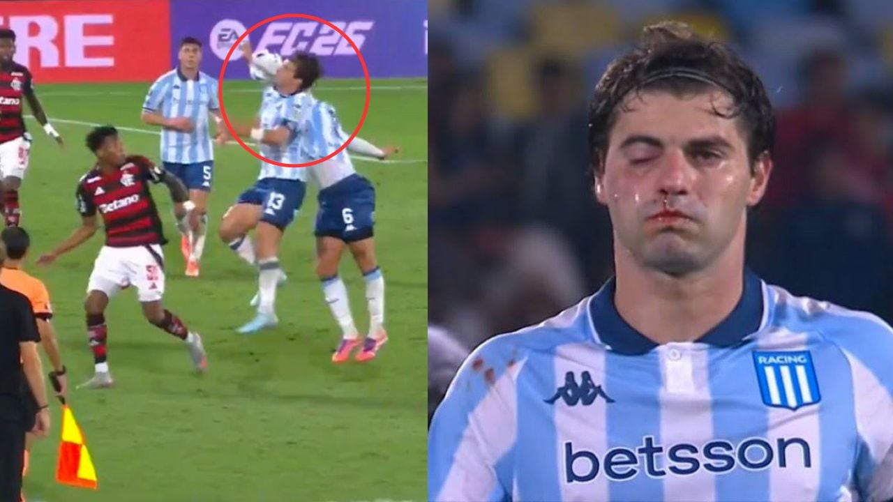 Santiago Sosa sufre fractura facial