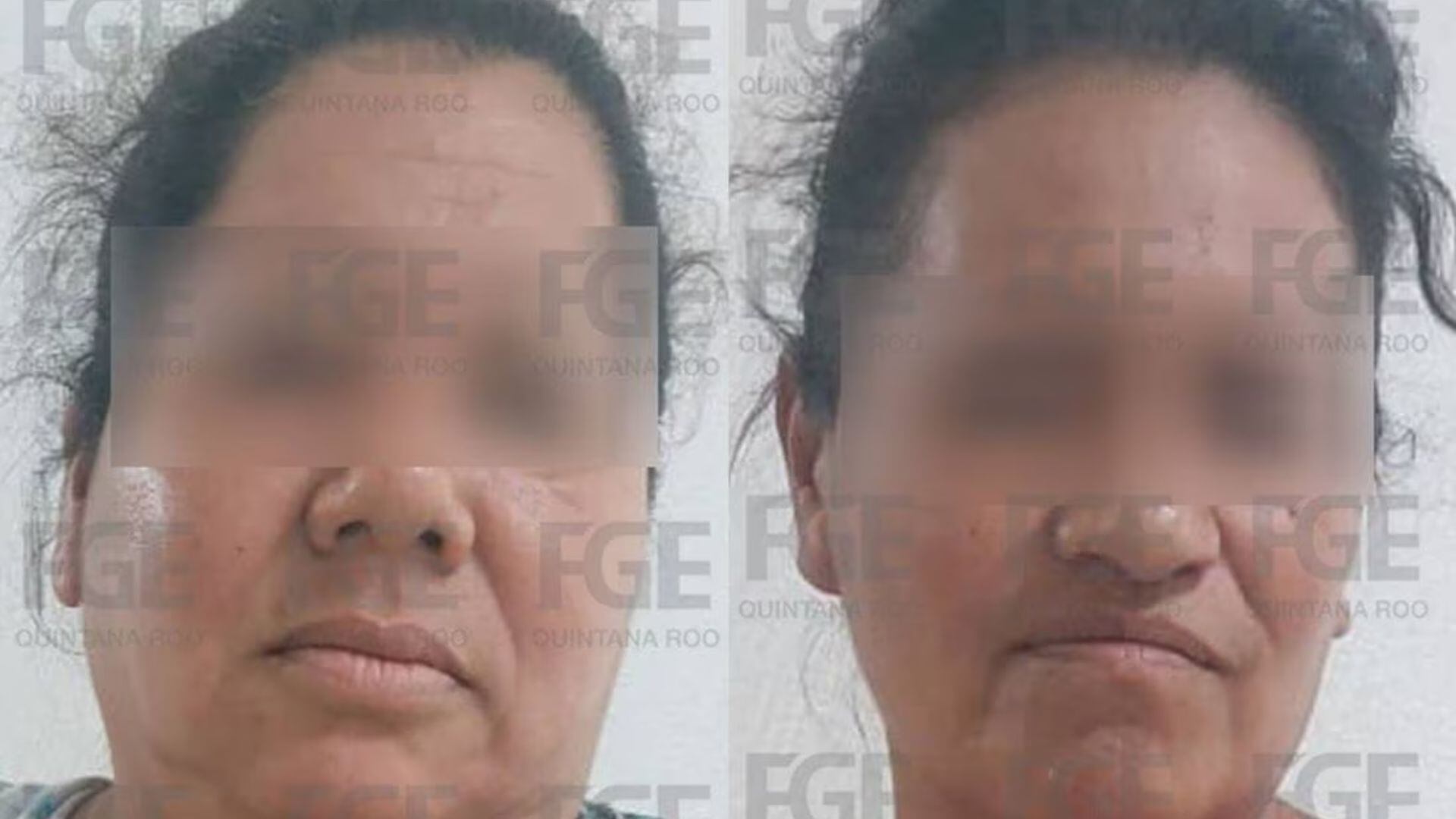 "Valentín" resultó con quemaduras de segundo grado en el 12% del cuerpo, principalmente en su rostro.