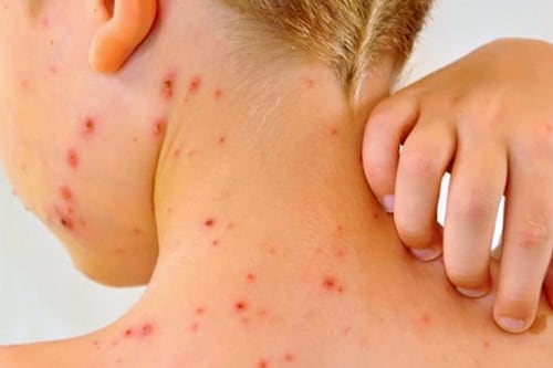 Arandas, epicentro del sarampión en Jalisco: 27 contagios en la última semana elevan la cifra a 70