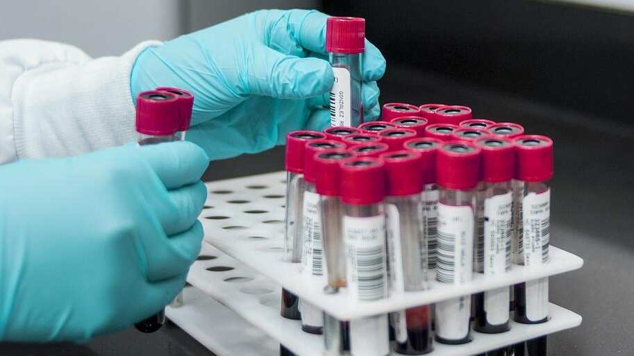 Muestras de laboratorio para descartar viruela del mono.