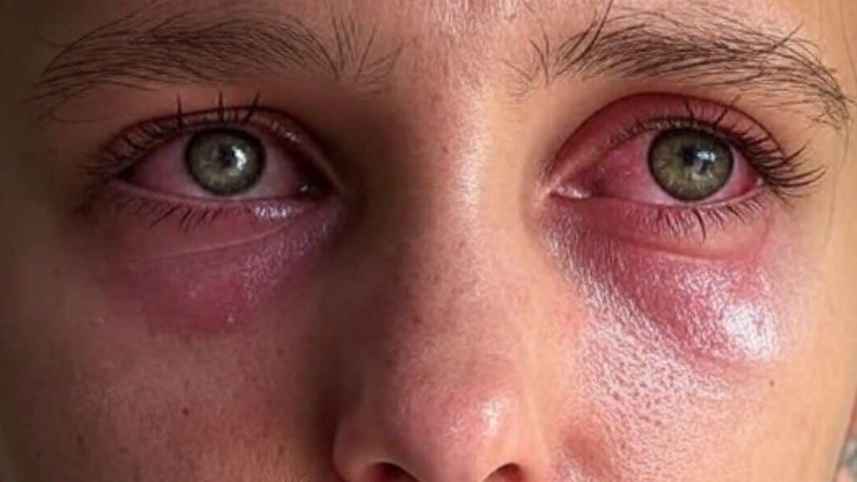 ¿Te lloran los ojos, sientes ardor? Podría ser una alergia ocular; conoce los síntomas