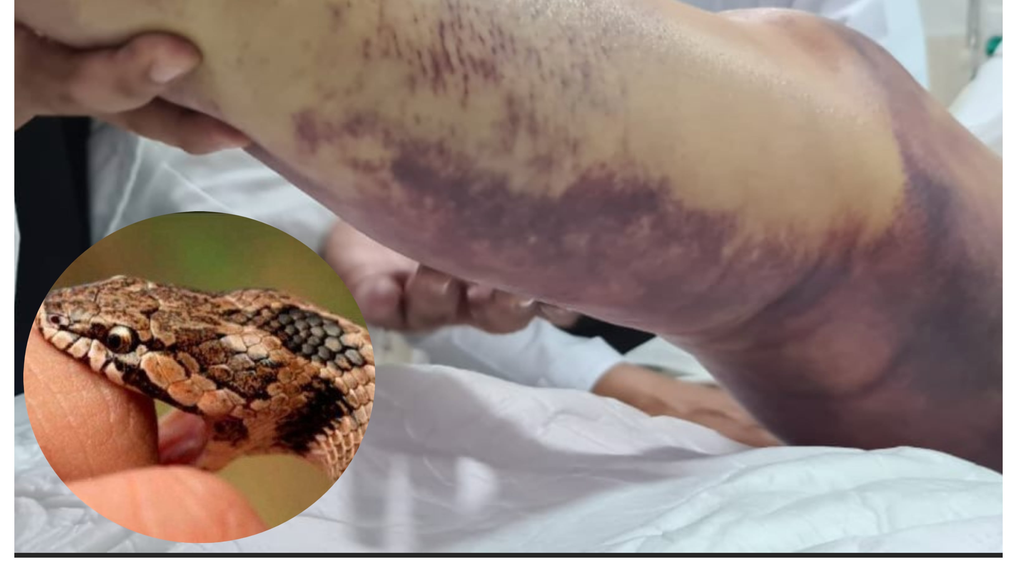 mordida de vibora