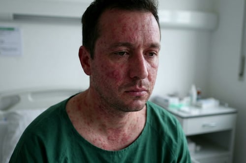 Casos de sarampión en Nuevo León suman ya 52; se registran tres en los primeros días de abril