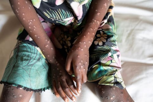 ¿Cuáles son los riesgos para los mexicanos ante la viruela del mono y cómo se contagia?