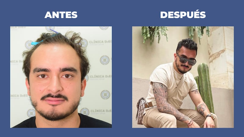 Descubre las causas de la calvicie y los tratamientos más efectivos disponibles, además de como mejorar la estética en la feminización y pacientes oncológicos
