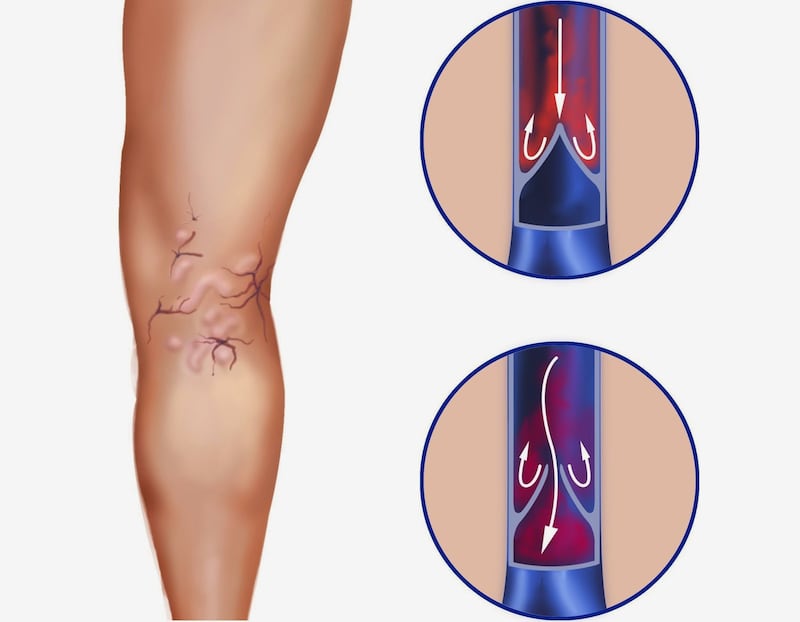 chronic venous insufficiency