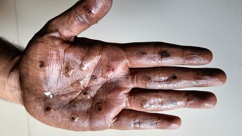 Monkey Pox.