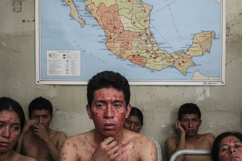 PAN exige declaratoria de emergencia sanitaria en CDMX por brote de sarampión