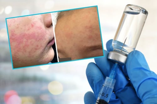 ¿Cuál es el riesgo de contagio de sarampión en EE. UU. por aumento de casos en México?