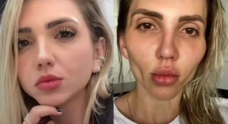 Bichectomía la operación que le desfiguró el rostro a la tiktoker Jéssica Frozza