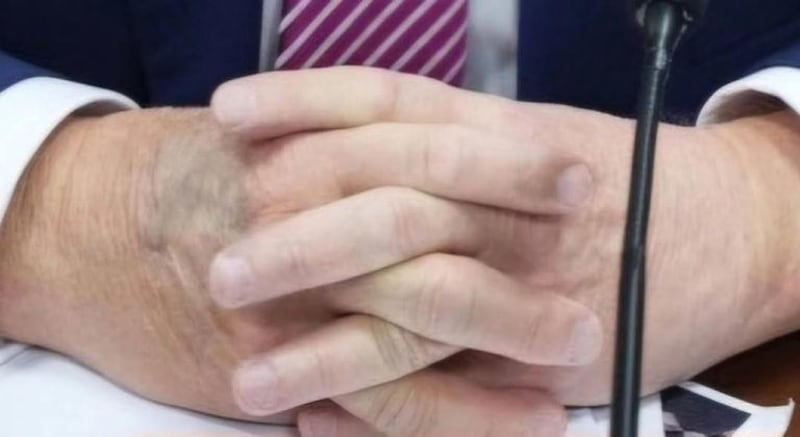 Mano de Trump presenta hematoma