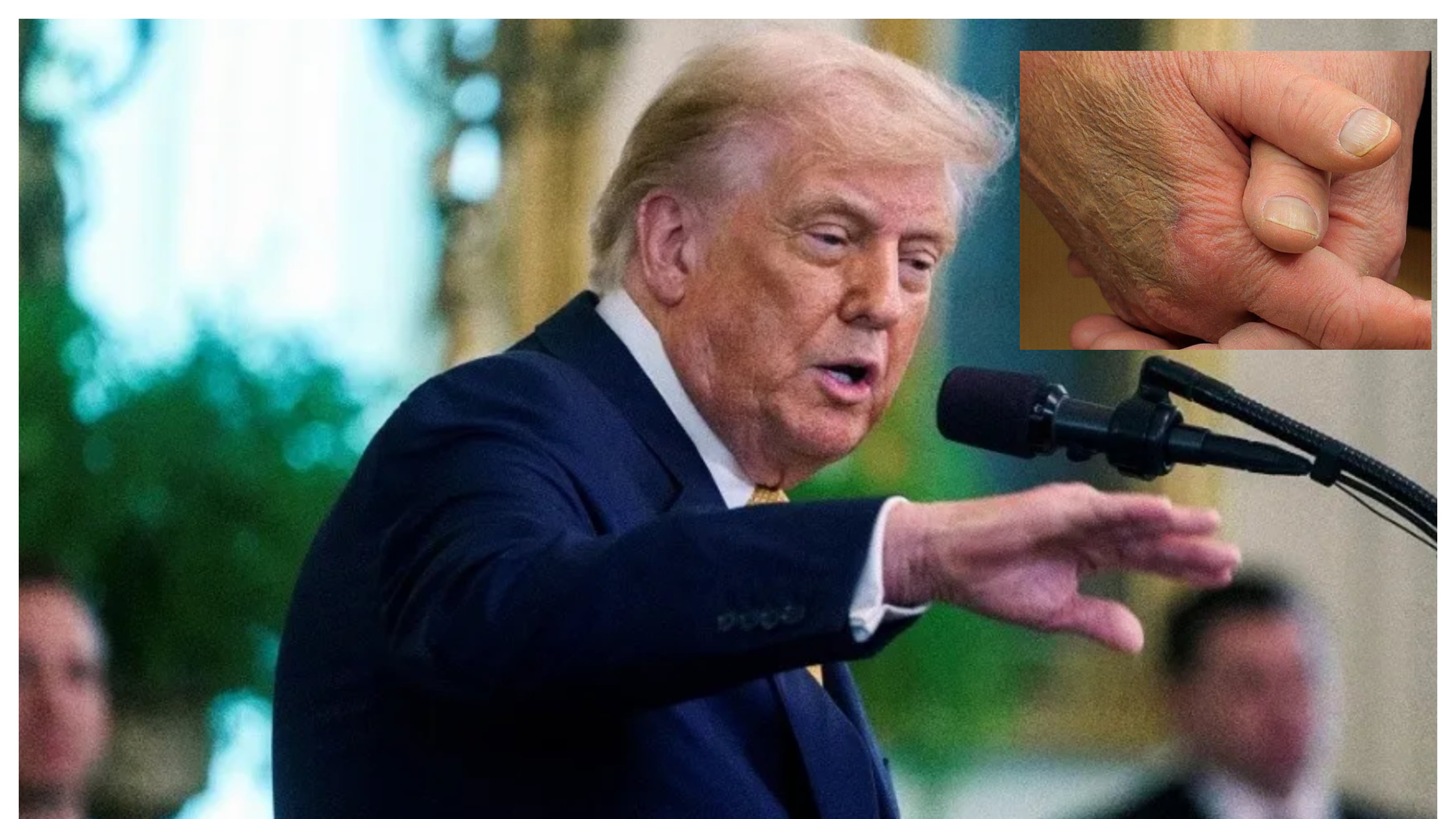 Trump hematomas en manos