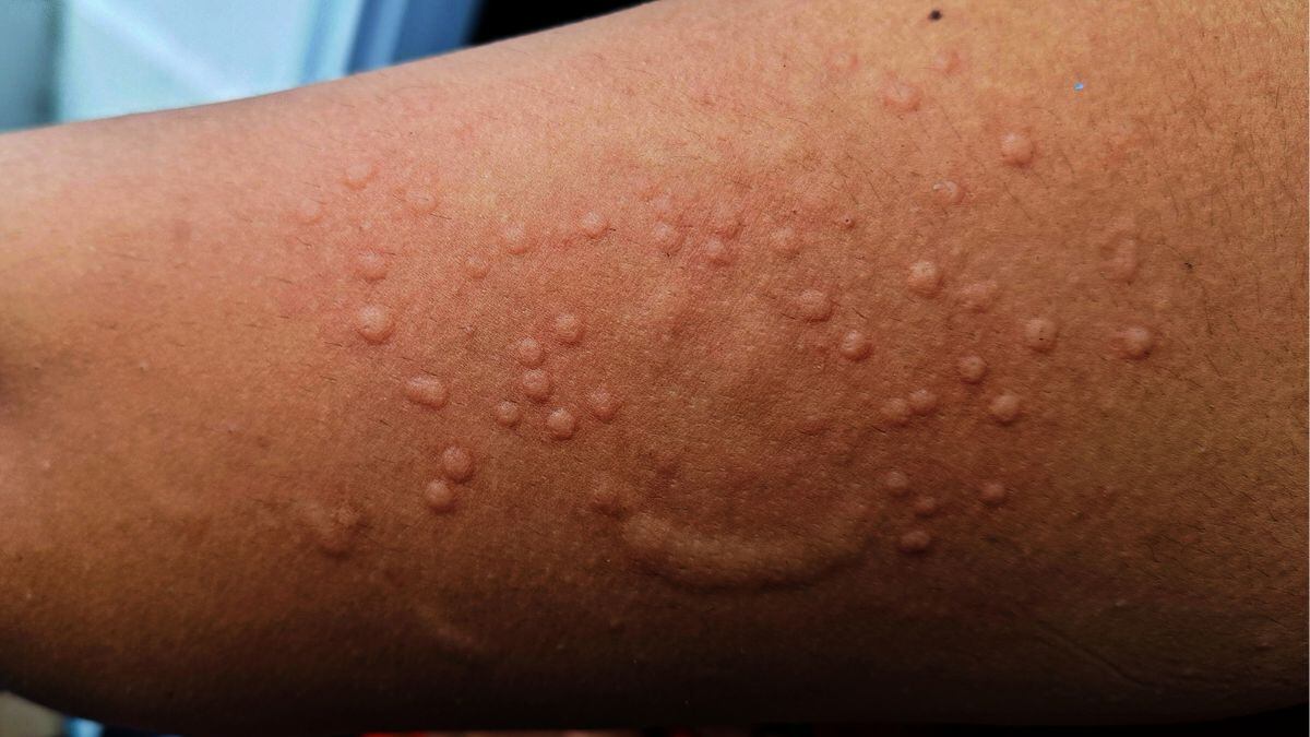 Viruela del mono en México: 61 casos confirmados de 291 sospechosos por mpox