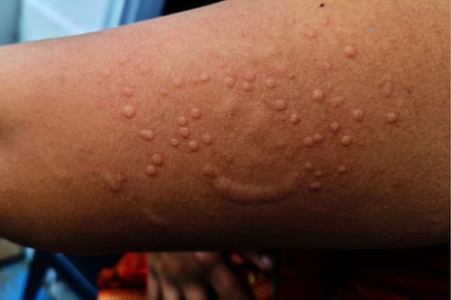 Caso confirmado de Mpox en Oaxaca; ¿está relacionado con supuesto brote en CDMX?