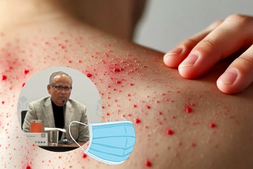 Con mil 779 casos de sarampión, confirman uso obligatorio de cubrebocas por 30 días en AMG