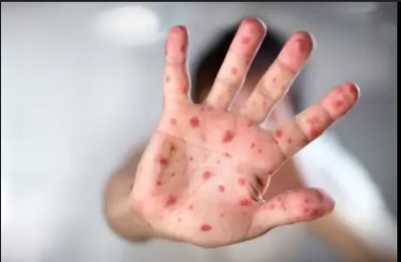 virus Coxsackie