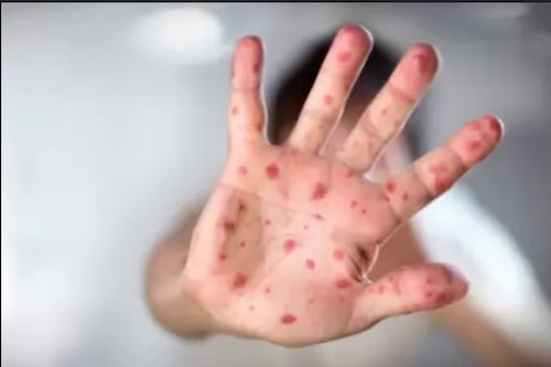 Brote de virus Coxsackie en Quintana Roo enciende alerta epidemiológica