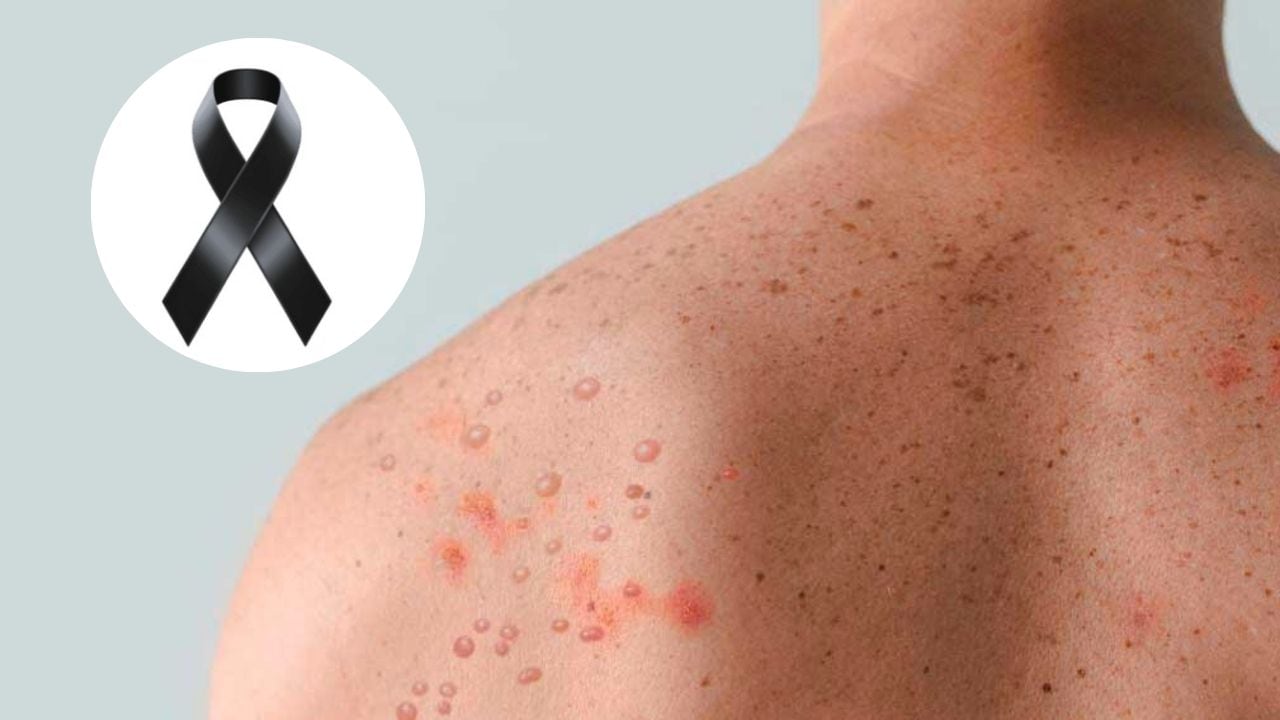 Michoacán registra el primer caso de sarampión