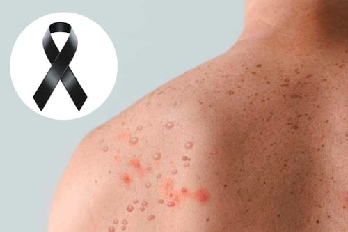 Alerta sanitaria: Se registra la primera muerte por sarampión en 2026