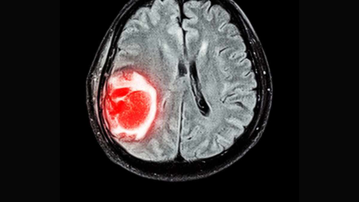 Síntomas del síndrome de Guillain-Barré, relacionado a vacunas contra Covid-19