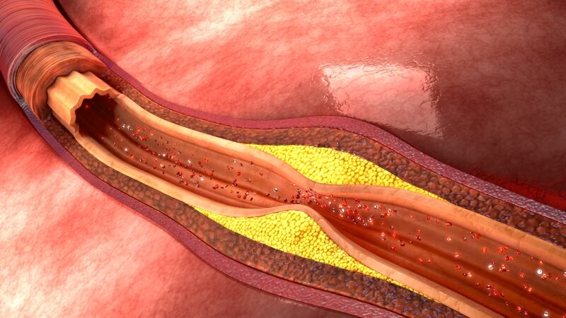 enfermedades cardiovasculares