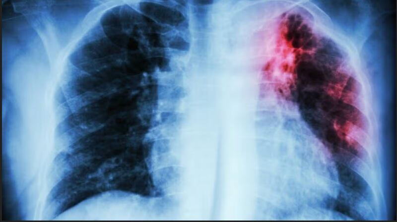 Fibrosis Pulmonar Progresiva