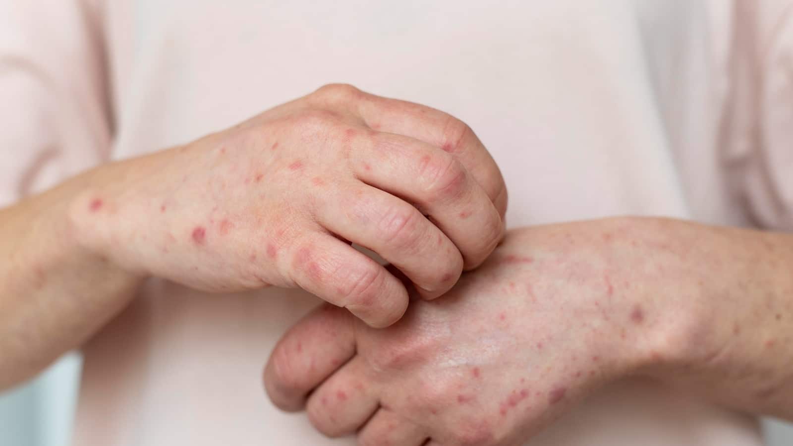 Detectan nuevo caso de sarampión en Querétaro; suman 9 contagios