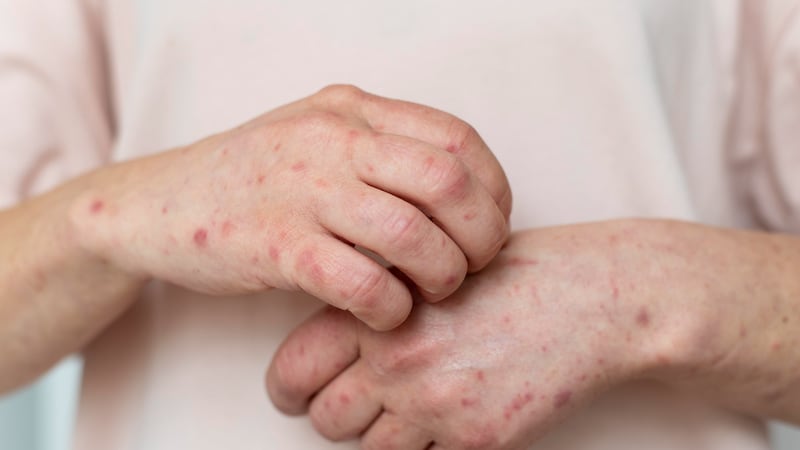 México detecta su primer caso importado de sarampión