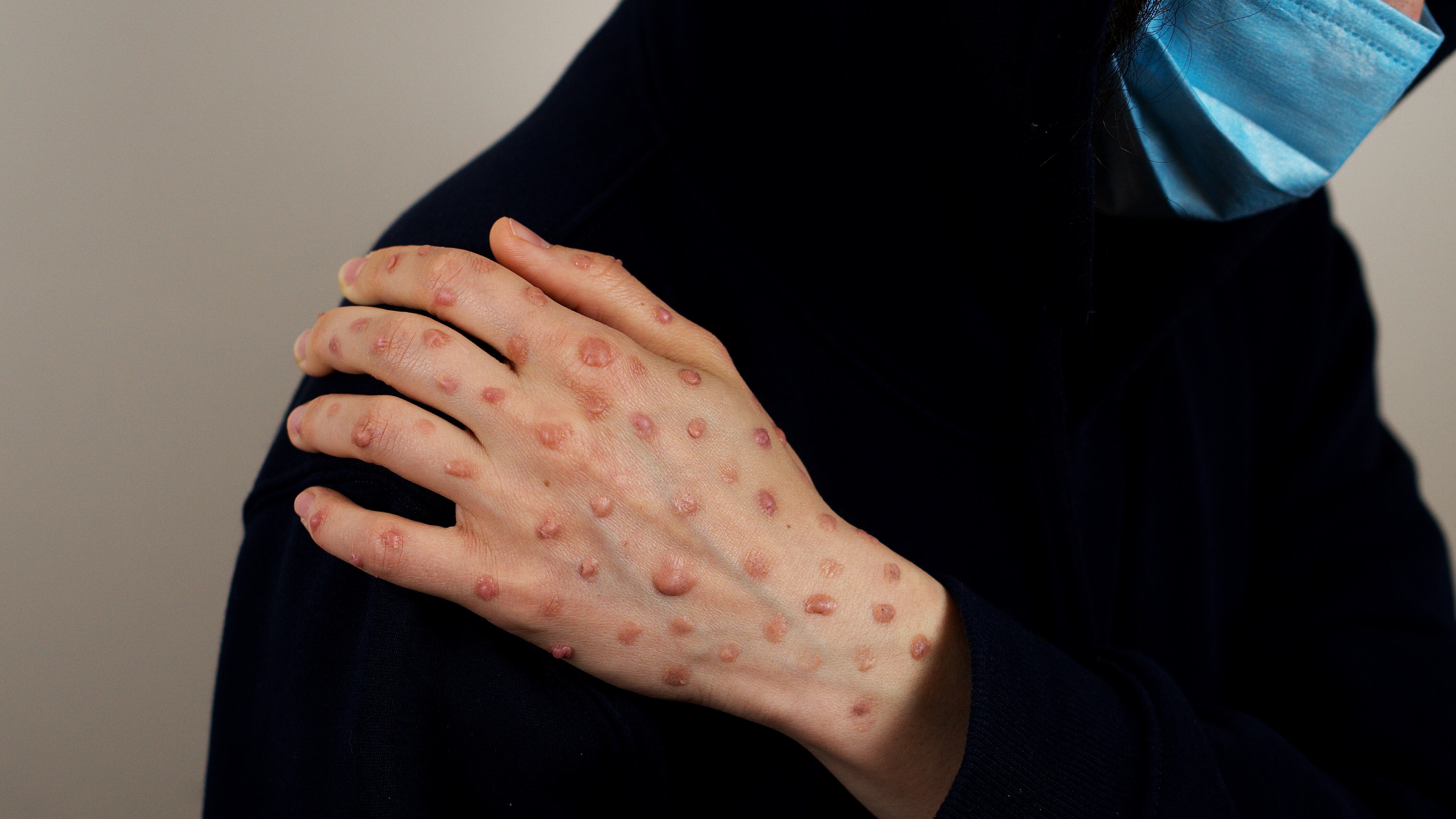 La enfermedad se transmitió de animales a humanos. (Dreamstime)