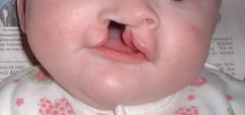 Los niños con labio leporino deben ser tratados por expertos.