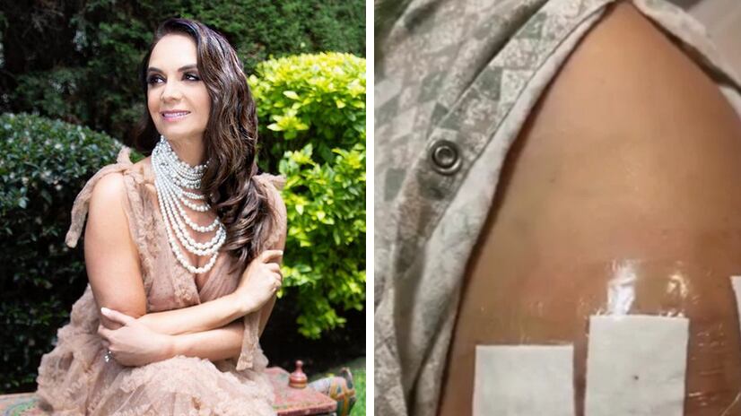 Lupita Jones, cirugía