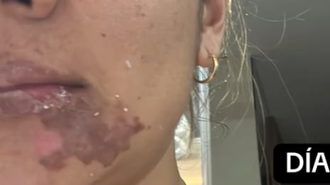 Mujer sufrió quemaduras al comer una empanada.