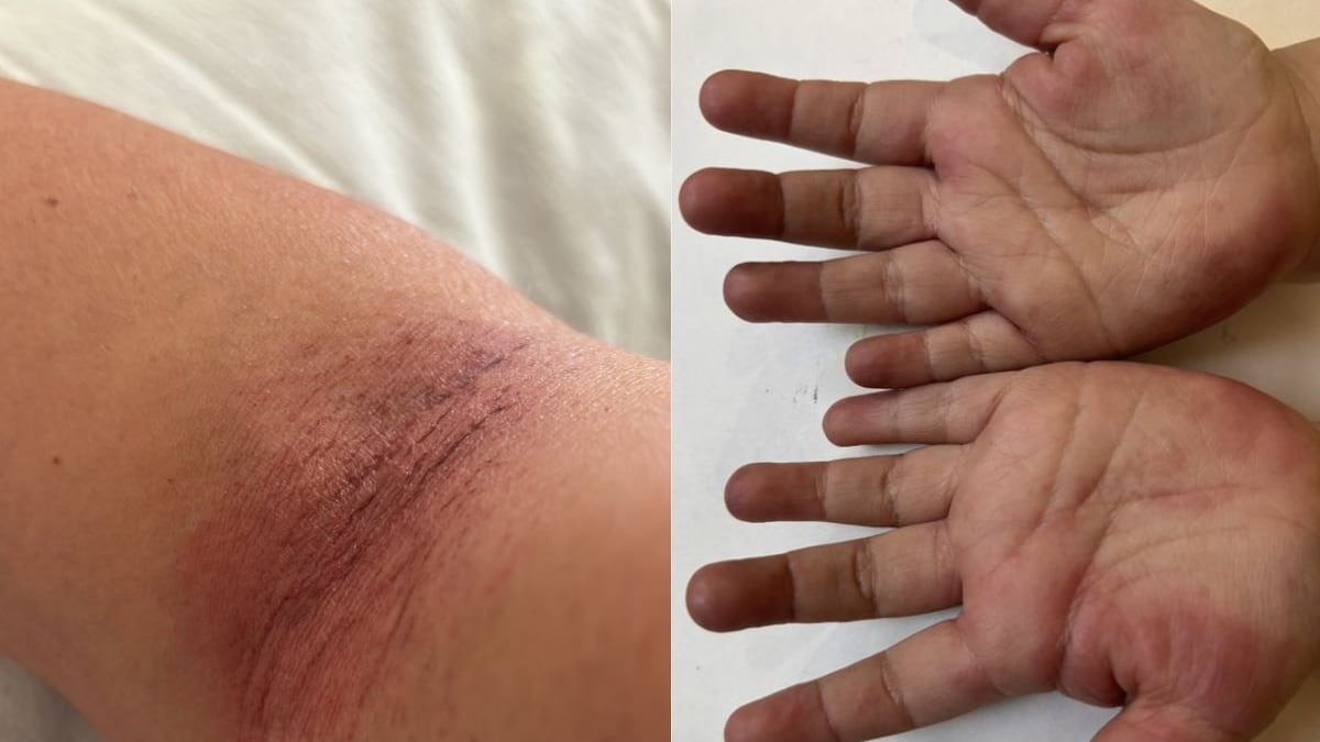 Agua contaminada: Infecciones y problemas de la piel entre vecinos de Benito Juárez